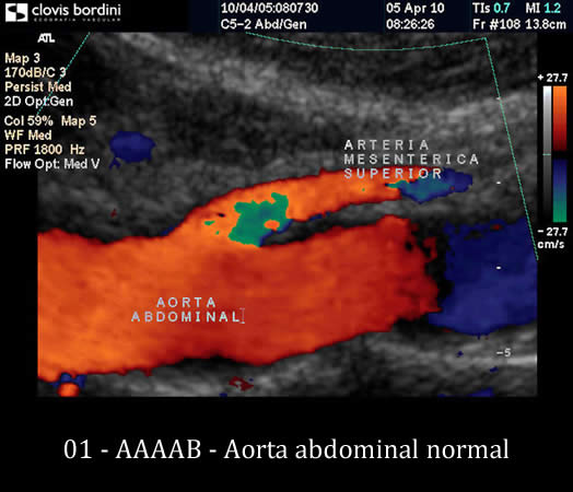 Aorta abdominal normal