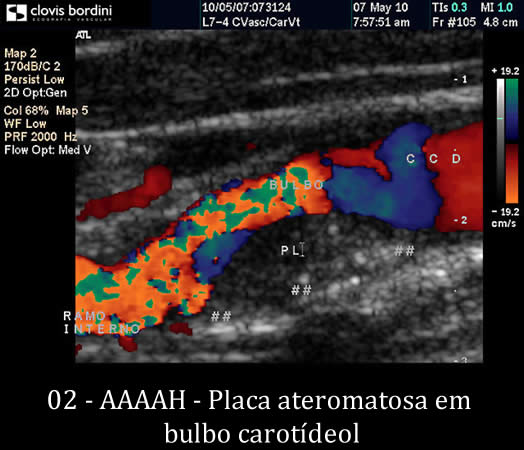 Placa ateromatosa em bulbo carotídeo