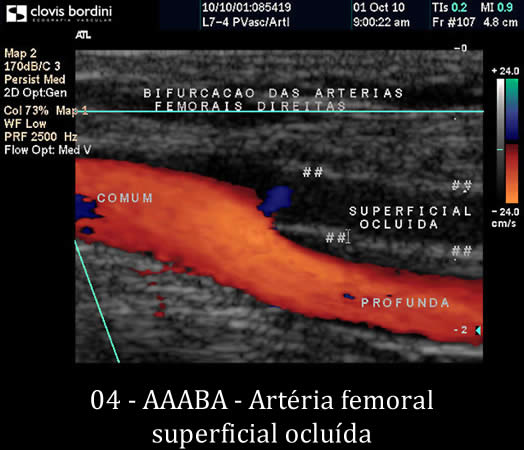 Artéria femoral superficial ocluída