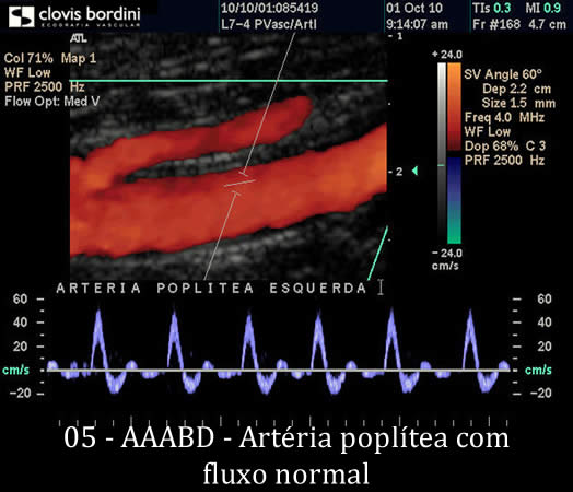 Artéria poplítea com fluxo normal