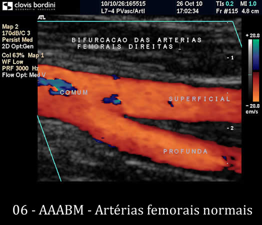 Artérias femorais normais