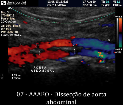 Dissecção de aorta abdominal