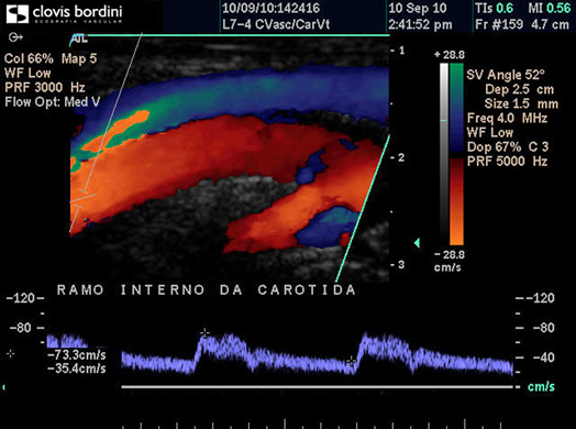 Ramo interno da carótida com fluxo normal