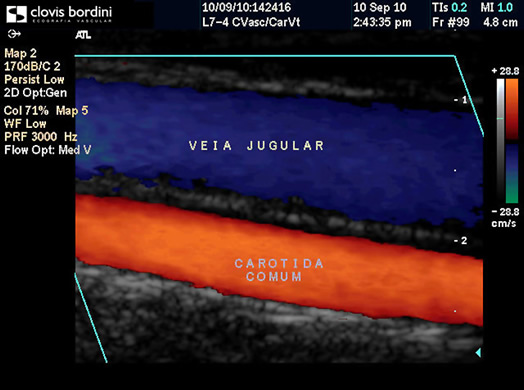 Carótida comum e veia jugular