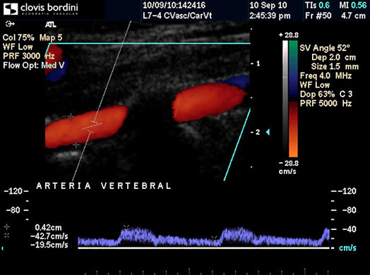 Artéria vertebral com fluxo normal