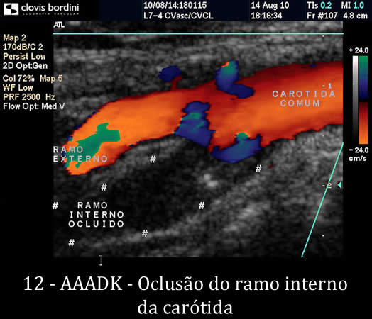 Oclusão do ramo interno da carótida