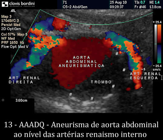 Aneurisma de aorta abdominal ao nível das artérias renais