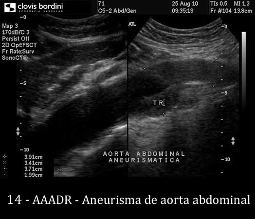 Aneurisma de aorta abdominal