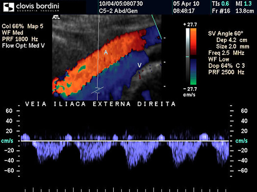 Veia Iliaca externa Direita