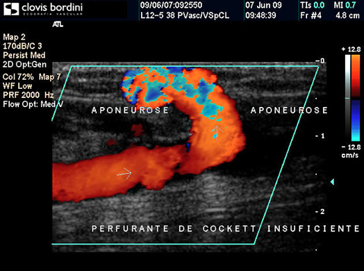 Perfurante de Cockett Insuficiente