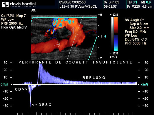 Perfurante de Cockett Insuficiente