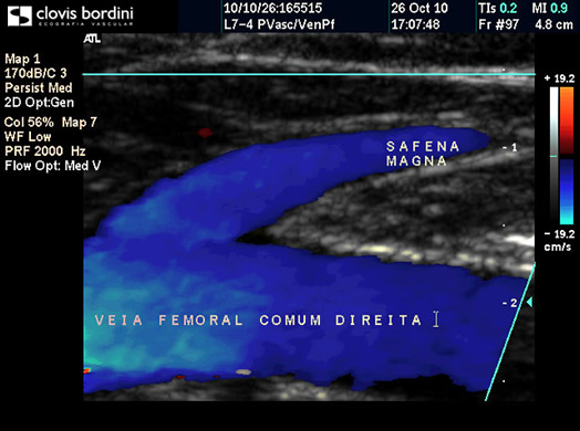 Veia Femoral Comum Direita