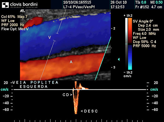 Veia Poplitea Esquerda