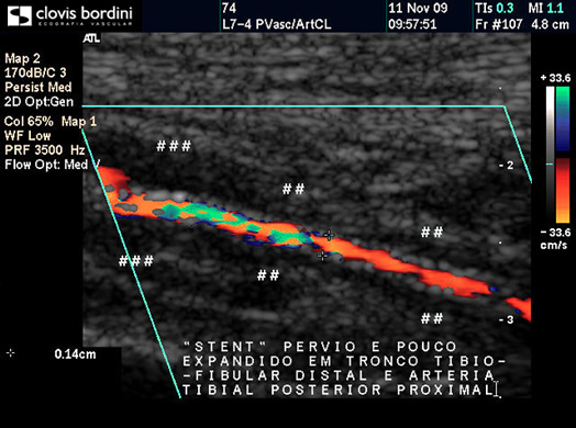 Stent - pervio e pouco expandido em tronco tíbio-fibular distal a Artéria Tibial Posterior Proximal