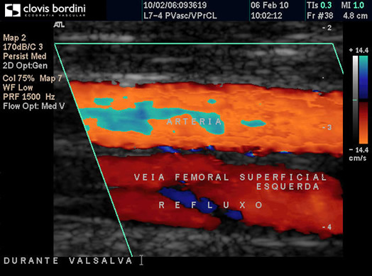 Veia Femoral Superficial Esquerda - Refluxo