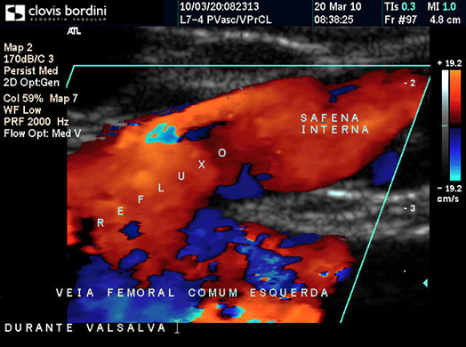 Veia Femoral Comum Esquerda