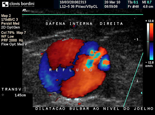 Dilatação Bulbar ao Nível do Joelho