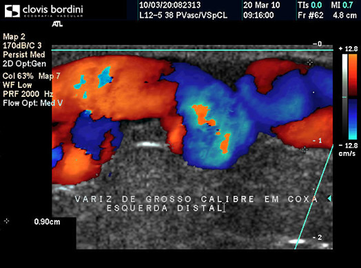 Variz de Grosso Calibre em Coxa Distal Esquerda