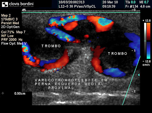 Varicotrombofleblite em perna direita medial proximal